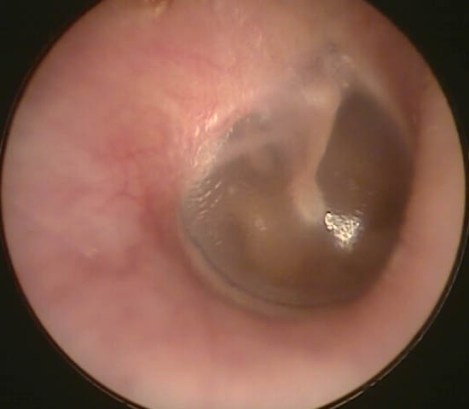 Normal Eardrum